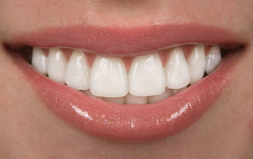 Porcelain-Veneers.jpg